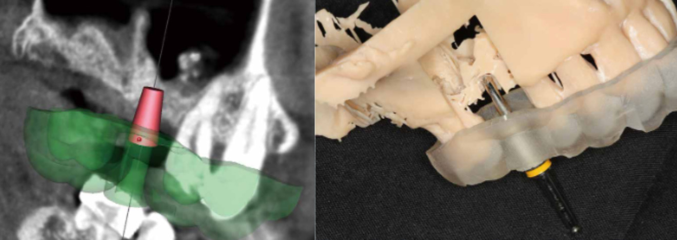 院長沈育群醫師研究:《Transcrestal sinus floor elevation with a minimal