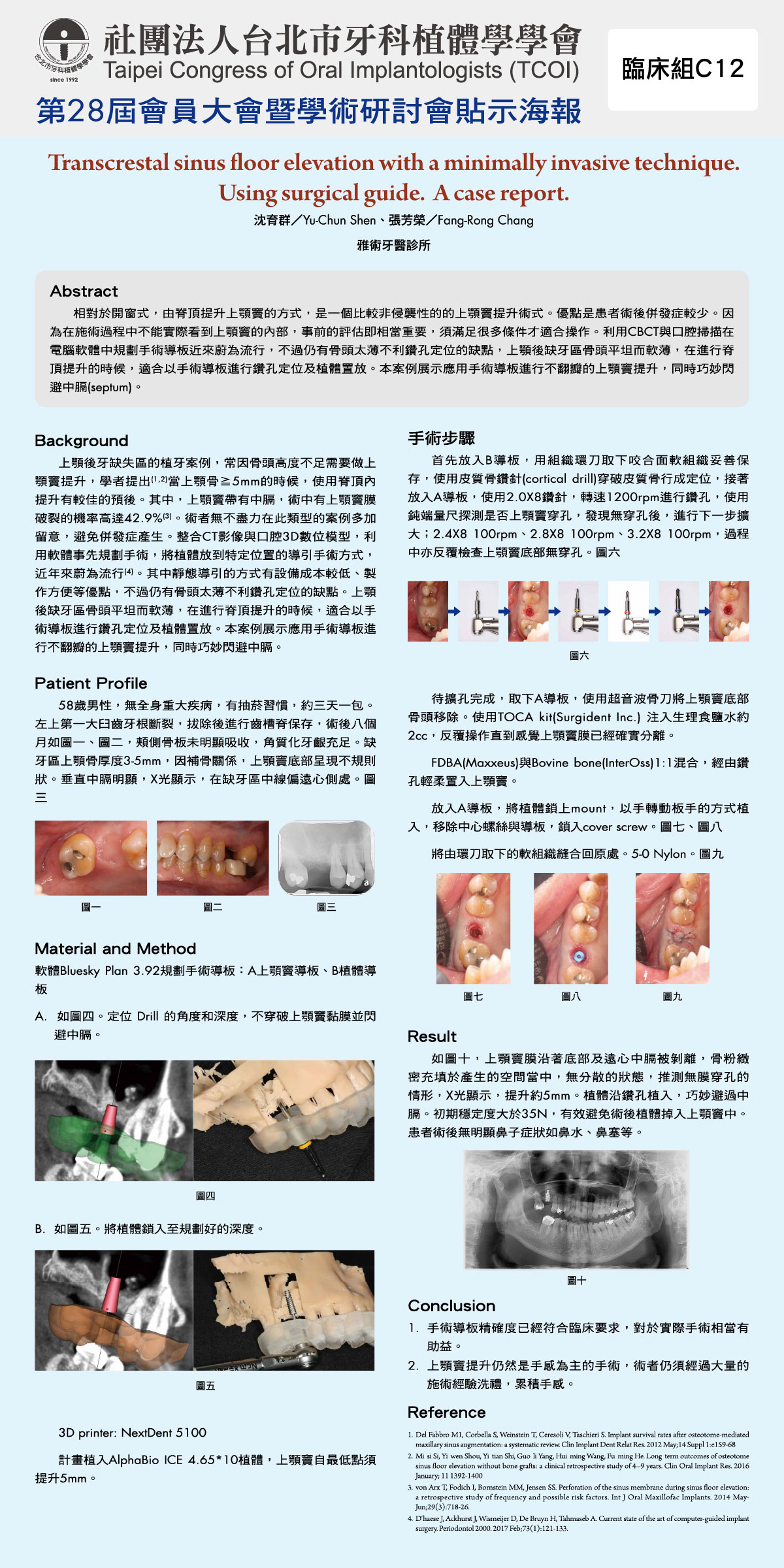 Transcrestal-sinus-floor-elevation-with-a-minimally-invasive-technique.Using-surgical-guide