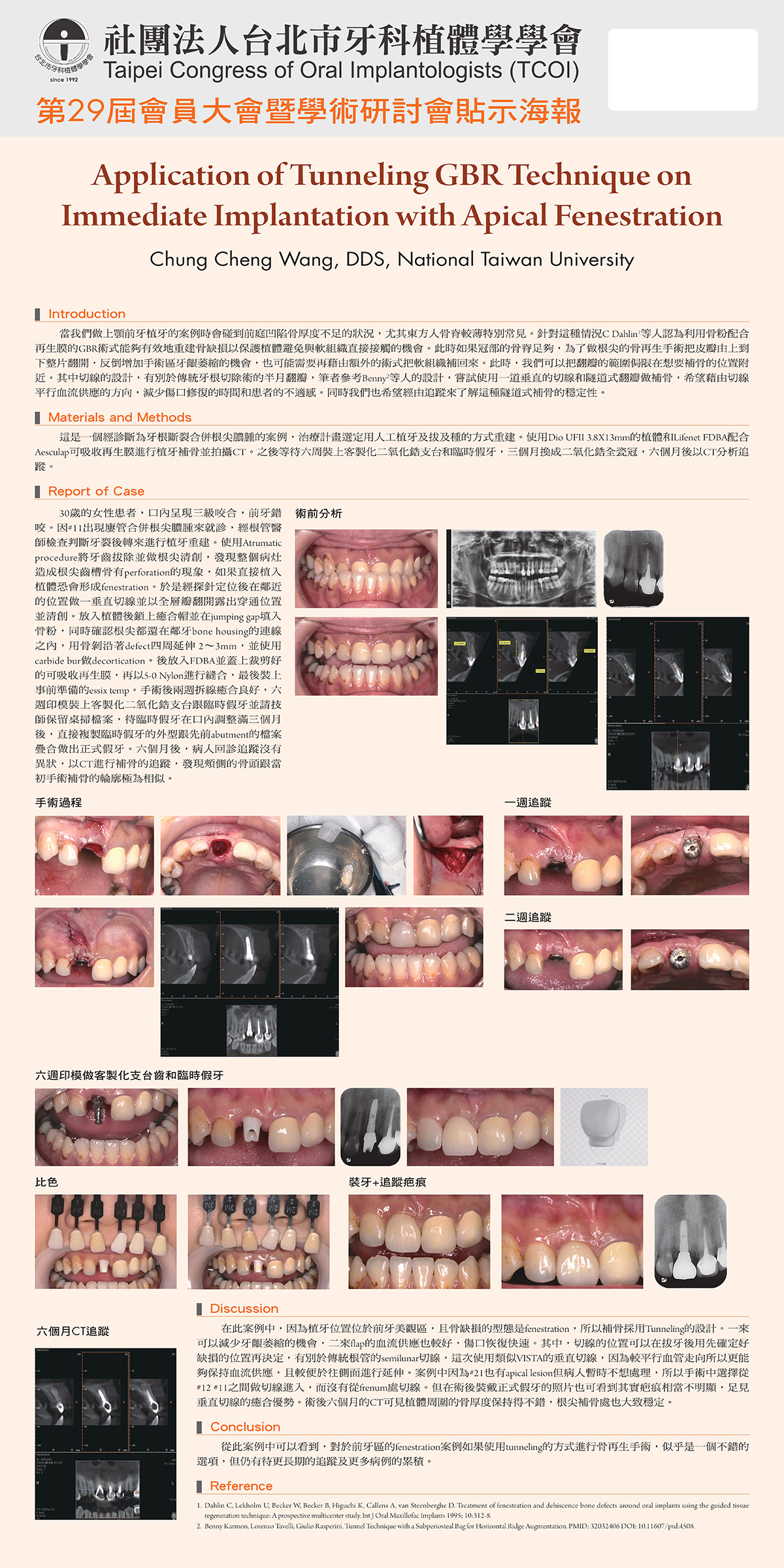 王崇丞醫師發表論文研究「隧道式GBR植牙技術應用」(Application of Tunneling GBR Techn