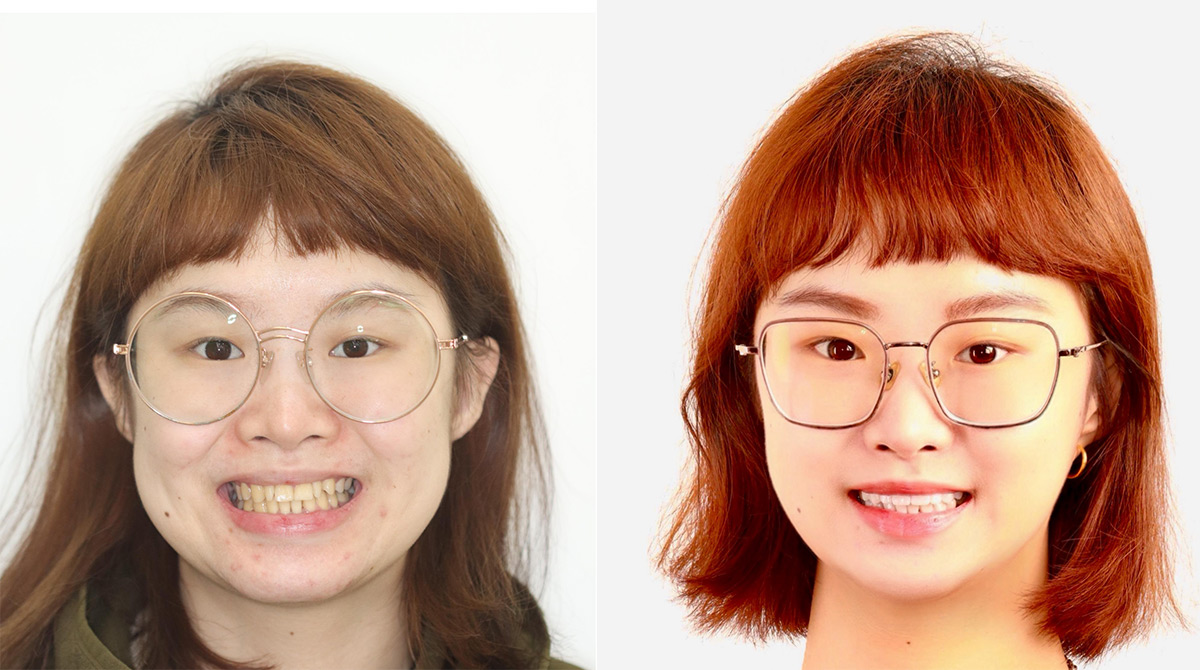 Bye Bye歪斜與色差， 4D晶鑽瓷貼片，展現個性美！