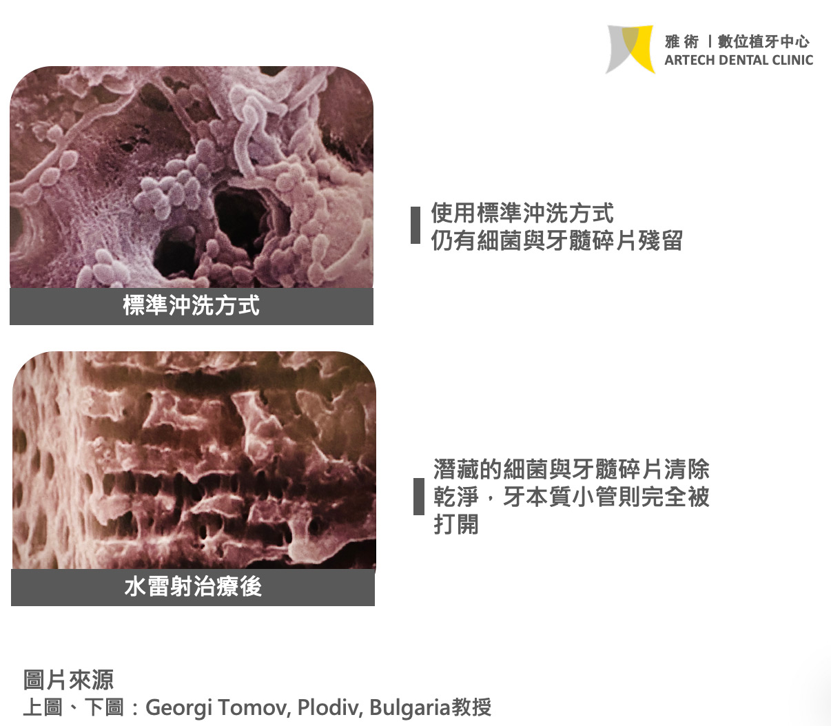 水雷射治療