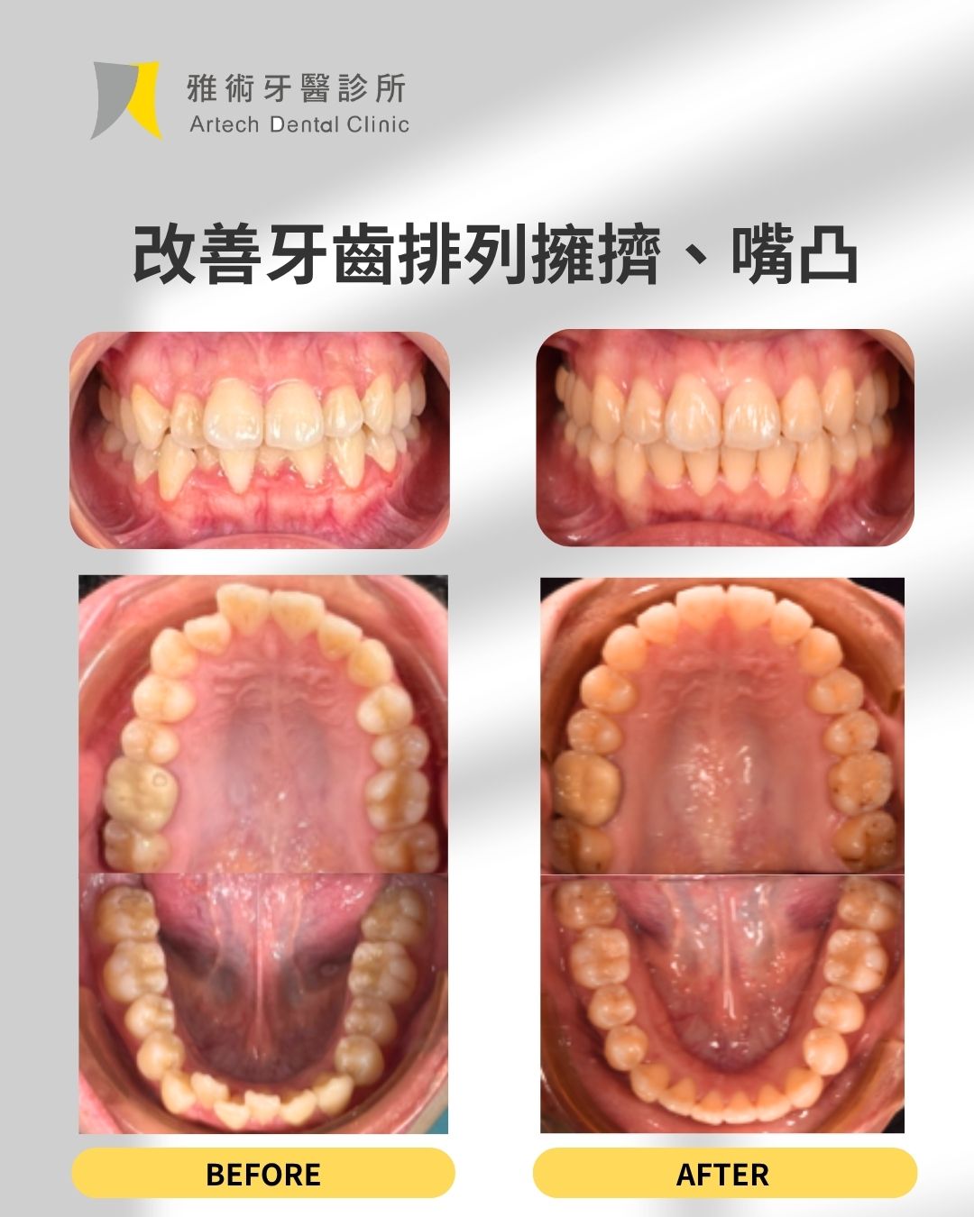 矯正，不只是 把牙齒排整齊