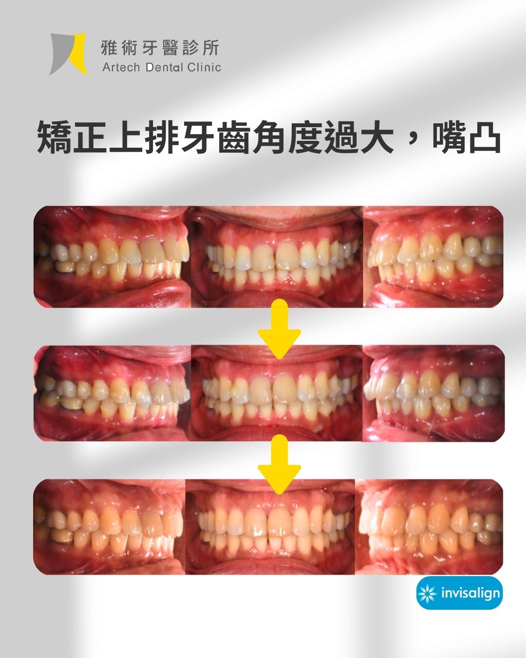 矯正，不只是 把牙齒排整齊 (3)