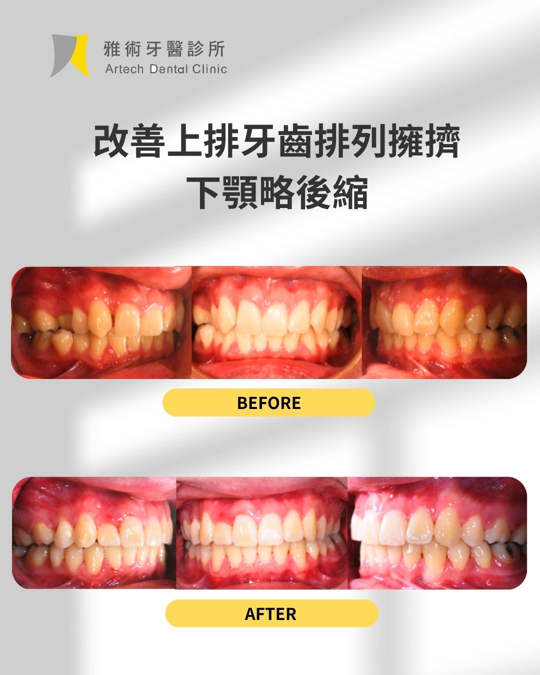 矯正，不只是 把牙齒排整齊 (4)