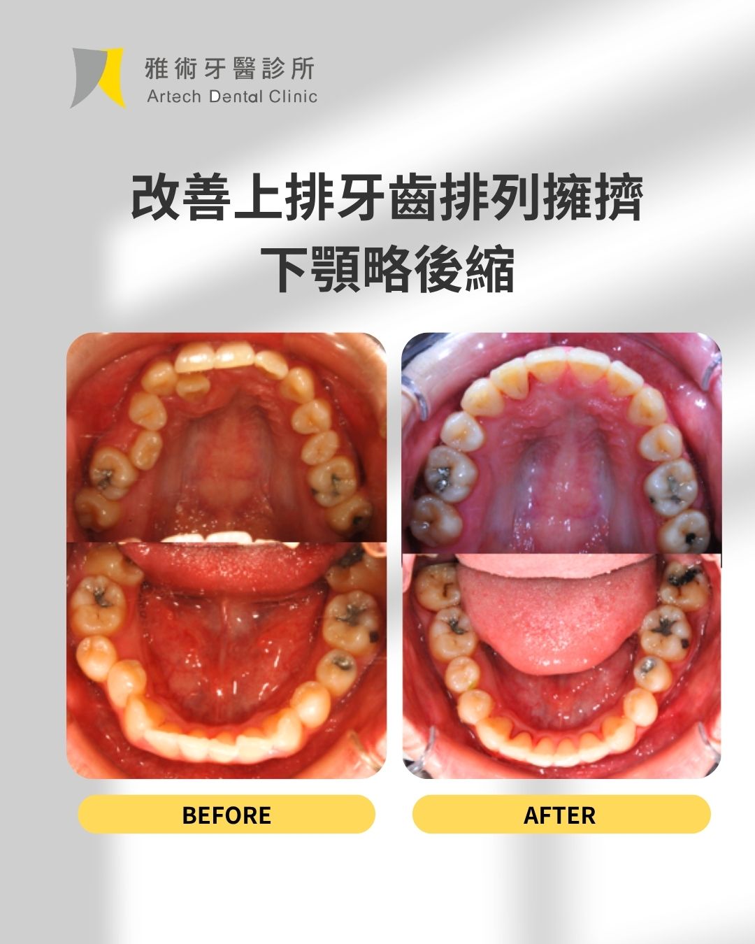 矯正，不只是 把牙齒排整齊 (5)
