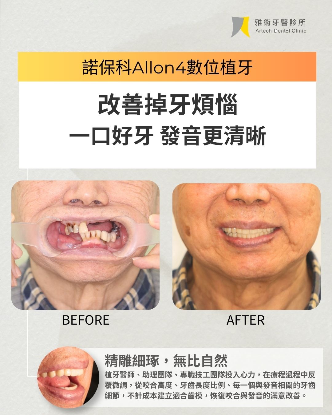 諾保科 All-on-4 植牙案例｜改善掉牙，重拾清晰發音，回歸專業表現